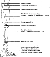 Niveaux d'amputation du membre inférieur