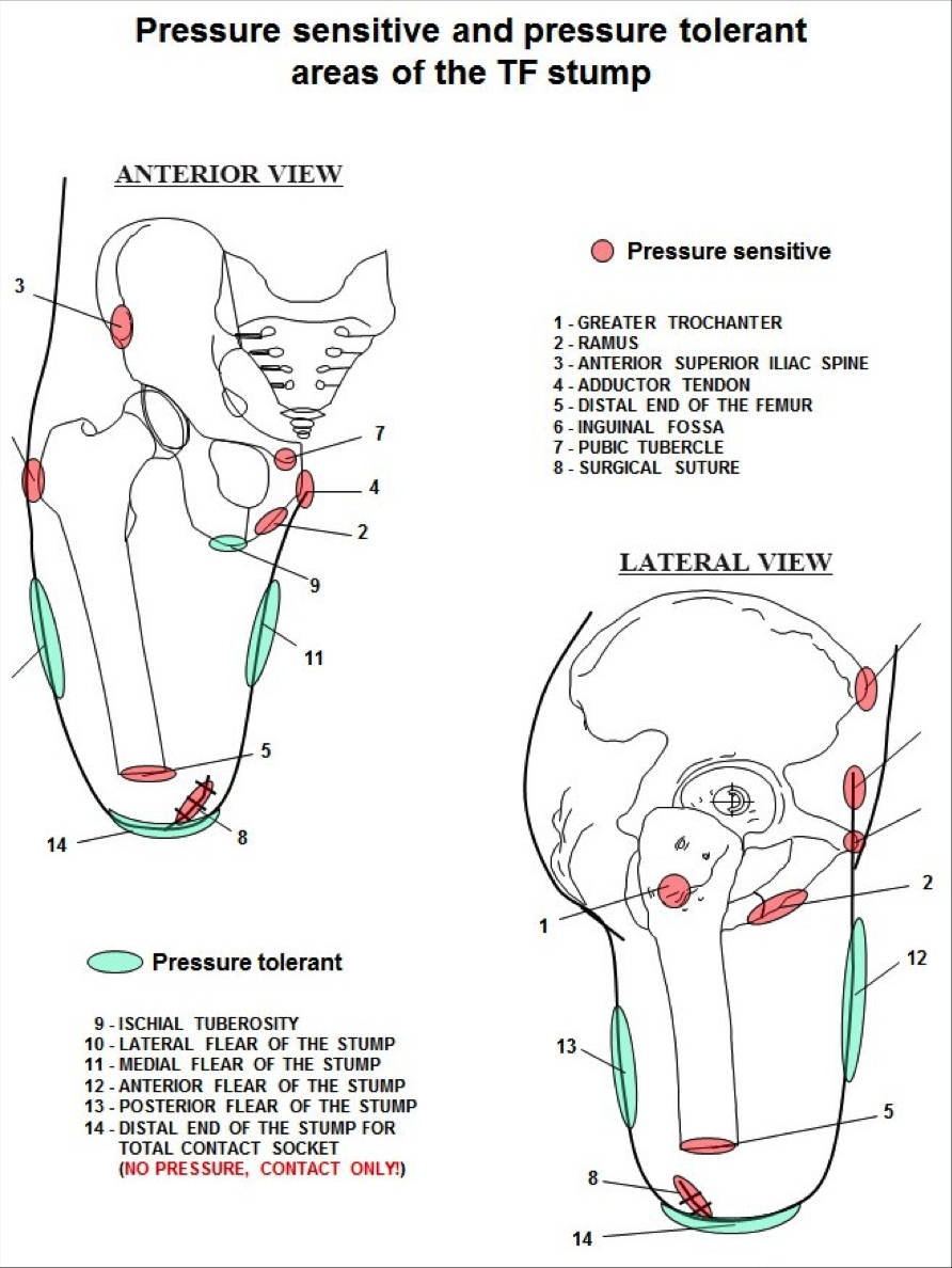 Zones d’appuis amputation TF