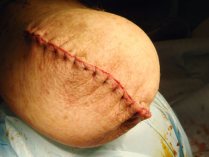 Suture réalisée