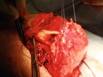 Recouvrement du tibia et de la fibula