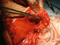 Réalisation de la suture