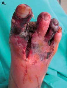 Nécrose pied