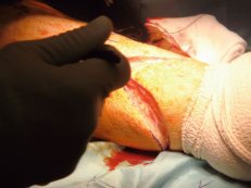 Séparation des compartiments musculaires
