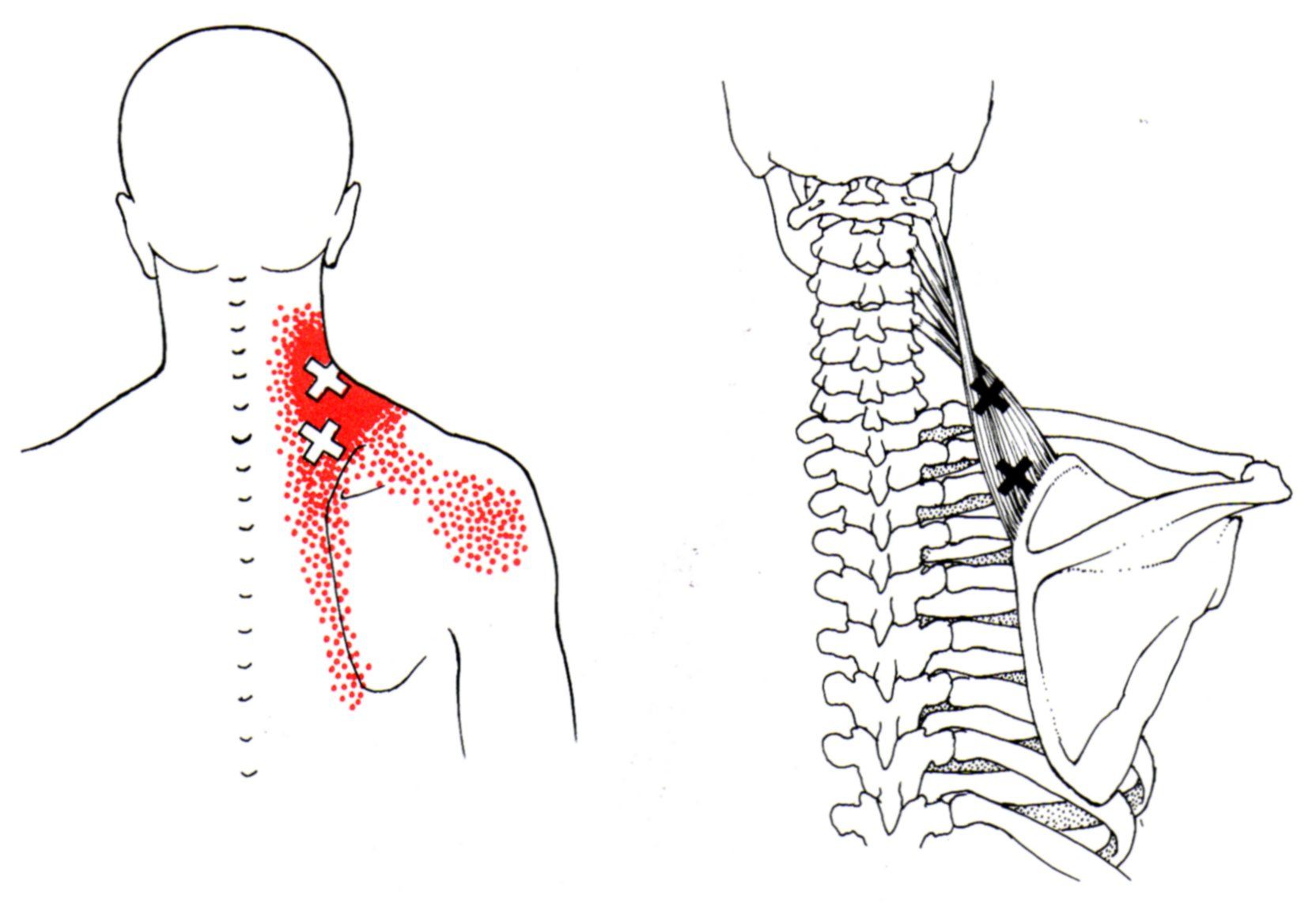 Trigger points de l'élévateur de la scapula