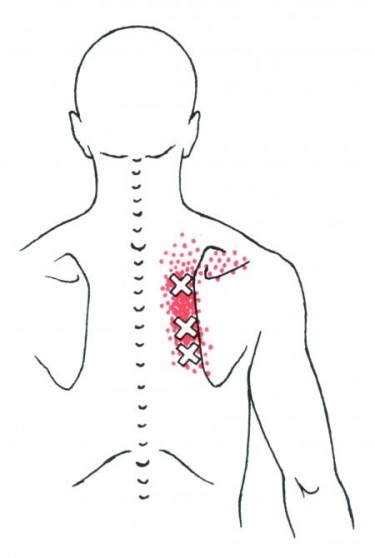 trigger points grand rhomboïde