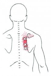 Trigger points du petit rhomboide