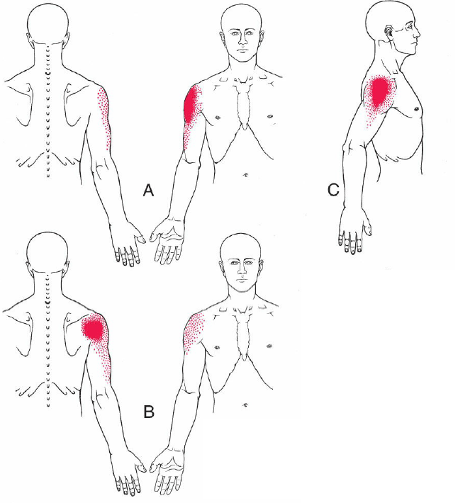 Trigger points du deltoîde