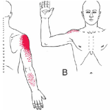 Trigger points du grand ron