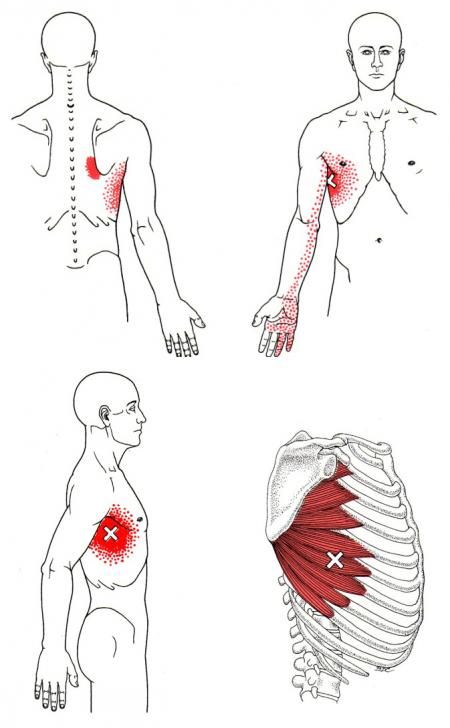 Trigger points du dentelé antérieur