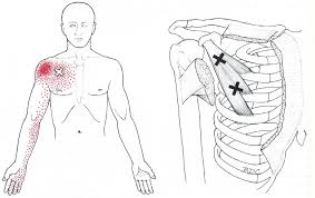 Trigger points petit pectoral