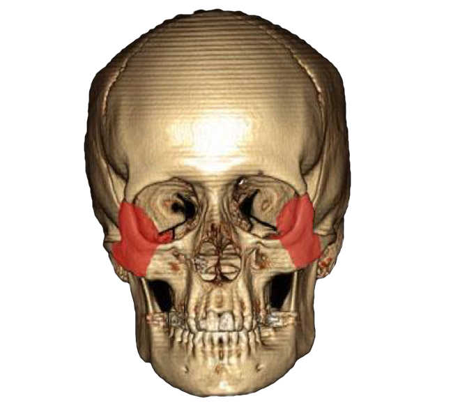 Os zygomatique vue de face